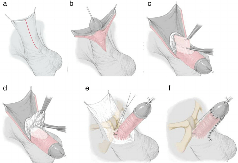 ligamentotomia a pénisz megnagyobbítására